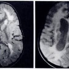 Advancing care for children with white matter disease: Pdf Mr Imaging Of White Matter Disease In Children