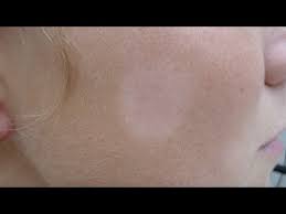 Pityriasis alba most commonly occurs in children with dark skin and involves white, slightly raised patches on the face. Pityriasis Alba Youtube