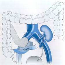 The major symptom of the disorder is muscle weakness, most often in the hip and shoulder areas, eventually making it difficult for patients. Pdf Transplantation In Diabetics With End Stage Renal Disease