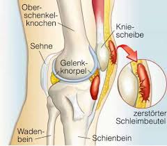 Knieschmerzen an der innenseite deuten häufig auf einen schaden am innenmeniskus hin. Schleimbeutelentzundung Bursitis Im Knie Gelenk Klinik De