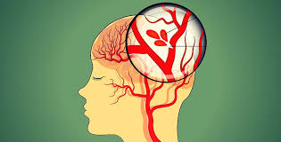 Un aneurisma cerebral es un ensanchamiento de un vaso sanguíneo en el cerebro. U8i0qdi6qj18dm