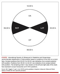 Image result for Manual Rotation in Occipitoposterior Presentation