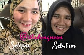 21,292 followers · beauty, cosmetic & personal care. Syafiqah Al Sebelum Dan Selepas Review Garden Of Eden Rosa E Untuk Parut Jerawat