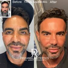 Dissolving Filler with Hyaluronidase