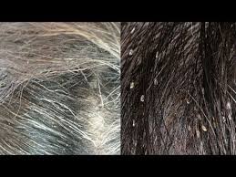 Head Lice Or Dandruff Ask The Expert 310 874 4550 Click Here For The No Guttate Psoriasis Treatment Psoriasis Remedies Scalp Natural Psoriasis Treatment