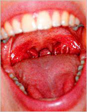 Burning Mouth Syndrome In Edmonton Ab Oral Problems