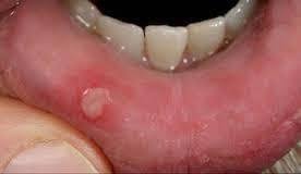 Dental prosthesis is also available to restore the normal appearance of the gums, teeth, and mouth. Be Aware Of Early Signs Of Mouth Cancer And Remedial Measures Steemit