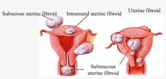 It has been popular that a healthy uterus is required for having a regular pregnancy and for great health of the female. Types Of The Patients Uterine Fibroids Table Fibroid Uterus Types Transparent Png 850x381 Free Download On Nicepng