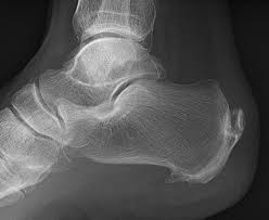 Spur meaning, definition, what is spur: Calcaneal Spur Wikipedia