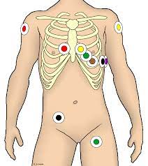 Im regelfall lassen sie diese elektroden beim arzt anlegen und tragen sie 24 stunden lang. Datei Ekg Ableitung Unter Rettungsdienst Bedingungen Png Wikipedia