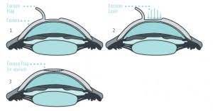 Welcome to thunder bay eye care. Eye Treatments In Iran Eye Surgery Clinics Costs