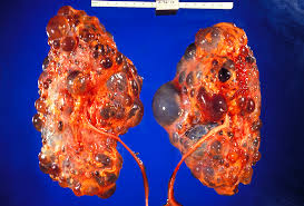 Polycystic Kidney Disease Wikipedia