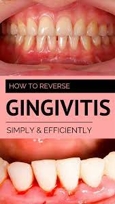 Tooth decay, gum disease, receding gums, bleeding gums gum disease is an epidemic. How To Reverse Gingivitis At Home Arxiusarquitectura