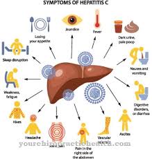 Ini adalah bentuk hepatitis c yang dikonfirmasi oleh adanya antibodi positif. Cryoglobulinemia Punca Gejala Rawatan Penyakit