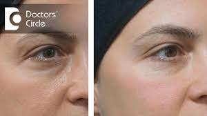 Depending on the depth of hollowness, you might have to spend more to get your desired result. What Is The Cost Estimate For Dermal Fillers In Under Eye Area Dr Rajdeep Mysore Youtube