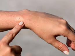 The bite of a black widow spider is dangerous because it can affect a person's nervous system. Spider Bites Identify What Bit You And Get Proper Help