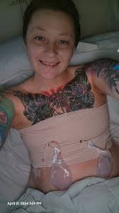 I had an operation yesterday to remove my implants with vontracture ,they  caused me a lot of pain . My wonderful Dr. Iakovos Georgiou did beautiful  stitches with great care! I feel