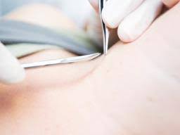 How to get rid of piles bleeding/hemorrhoid skin tag at home | bawaseer ka ilaj | anam home remedyplease support us by like and share our more videos :) disc. Anal Skin Tag Removal Recovery And Prevention