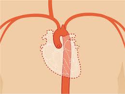 Thrombosed hemorrhoids is a type of hemorrhoid with a clot that partially or fully blocks blood flow. Thrombosed Hemorrhoid Symptoms Causes And More