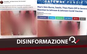 As well, the johnson & johnson vaccine can be kept at essentially refrigerator temperatures for months, and it's stable. Il Vaccino Johnson Johnson Causa Gravi Danni Alla Pelle Spieghiamo Il Rarissimo Caso Americano Open