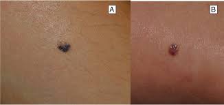 Image result for Spitz Nevus