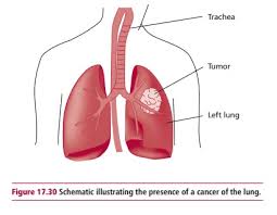 See pictures of lung cancer. Lung Cancer Classification Treatment Signs Symptoms Diagnosis And Staging