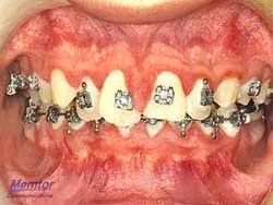 Read up on proper daily cleaning with braces! Oral Hygiene Carcara Orthodontics