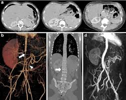 What's the survival rate of stage iv blood cancer patients? Imaging Studies Of A Girl With Stage Iv Neuroblastoma Who Developed Download Scientific Diagram