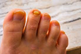 Image result for Yellow nail syndrome feet