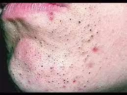What Is The White Substance That Comes Out Of My Pores Everytime I Squeeze My Nose Or Chin And How Should I Clean These Parts Of My Face Quora