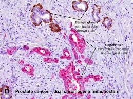 Prostate cancer is the most common noncutaneous cancer among males, making the diagnosis … Prostatic Adenocarcinoma General Features American Urological Association