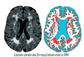 Check spelling or type a new query. Suplimentele De Calciu Asociate Cu Leziuni La Nivelul Creierului Medical Journals Medical Health