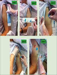 More images for bomba de sedacion paliativa » Protocolo De Actuacion Sobre El Manejo De Infusores Continuos