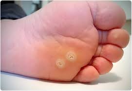 Image result for verrucae filiformes