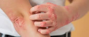 Image result for Skin Infection
