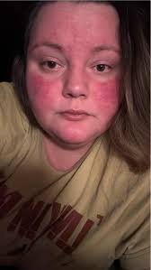 Treatment options for scarring from Hidradenitis Suppurativa