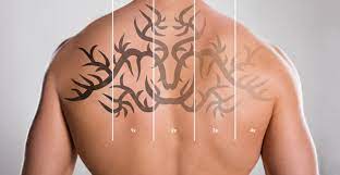 Laser tattoo removal before and after patient photos from roseville plastic surgery specialist dr. Sacramento Tattoo Removal Elegant Arts Tattoo