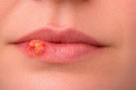 How to Get Rid of a Cold Sore – Complete Treatment Guide