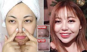 Want to know how to remove blackheads fast? This Blackhead Removal Hack Is Going Viral But It S Not A Good Idea Daily Mail Online