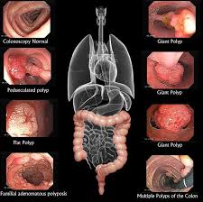 Pin On Diverticulitis Natural Remedies