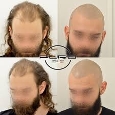 Effetto ricostruttivo o di infoltimento pre/post autotrapianto di capelli . Tricopigmentazione Augusto Mirko Di Lascio E Tecnico Beauty Medical Puroart