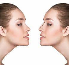 What causes a deviated septum? Nasal Septal Surgery Septoplasty Miami Ft Lauderdale