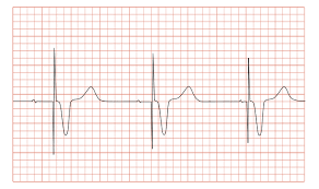 Usually these spikes are more visible in unipolar than in bipolar pacing. File Ecg Pacemaker Syndrome Svg Wikimedia Commons
