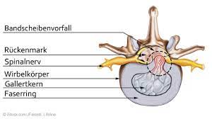 Bandscheibenvorfall Symptome Und Was Tun