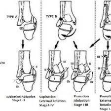It has three categories type a. Pdf Ankle Fractures A Literature Review Of Current Treatment Methods
