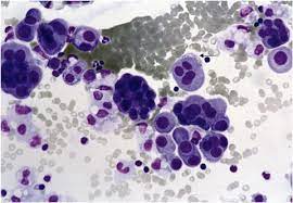 To evaluate this, cytology, pathology, and medical records of 26 cases in 21 patients who underwent extrapleural pneumonectomy because of malignant mesothelioma were reviewed. Pathologic Diagnosis And Classification Of Mesothelioma Springerlink
