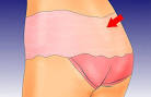 Mycoses et sexualit : quels liens? - Sexualit - Version Femina