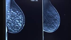 1 ﻿ the gray areas correspond to normal fatty tissue, while the white areas are normal breast tissue with ducts and lobes. Guthrie Catching Breast Cancer At Earlier Rates Thanks To 3d Mammography