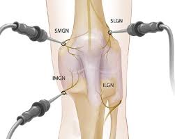 Image result for Radiofrequency Surgery