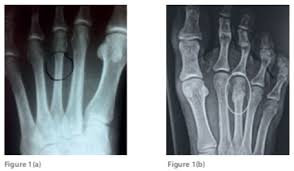 Stress fractures tend to occur in runners' pelvic areas, legs or feet. Metatarsal Stress Fracture Excluding 2nd And 5th Mt Sports Clinic Nq